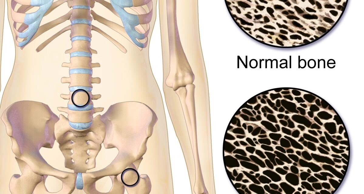 Should Women with Osteoporosis Engage in High Intensity Resistance and Impact Training?