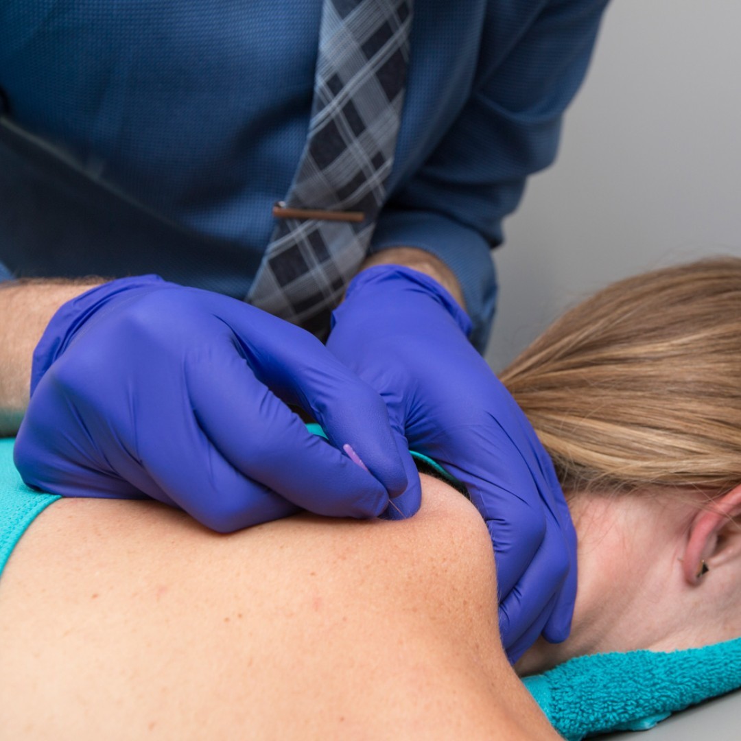 Trigger Point Dry Needling (TDN) - Boulder Therapeutics