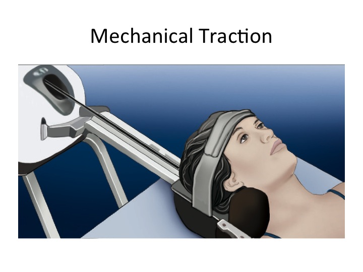 Mechanical Traction in Physical Therapy