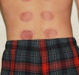 cupping-treatments-low-back-pain