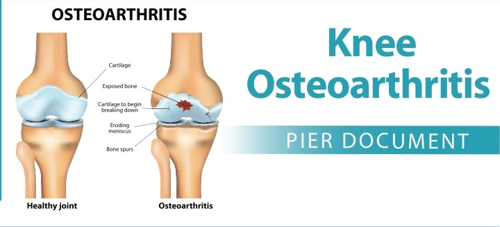 knee arthritis, physical therapy, knee pain