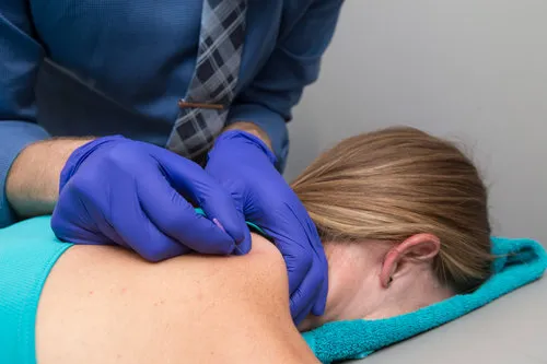 Boulder Dry Needling Treatment