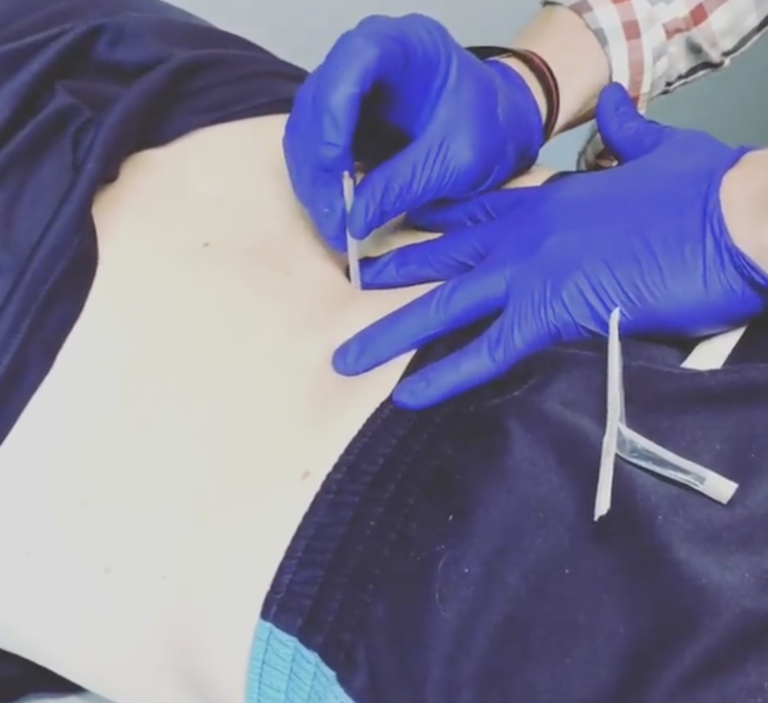 Mend Colorado Physical Therapy Boulder Lafayette Dry Needling Low Back Pain