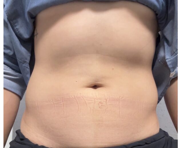 Abdomino-phrenic dyssynergia (APD).When Things Go Sideways: APD and Upper Abdominal Dominance