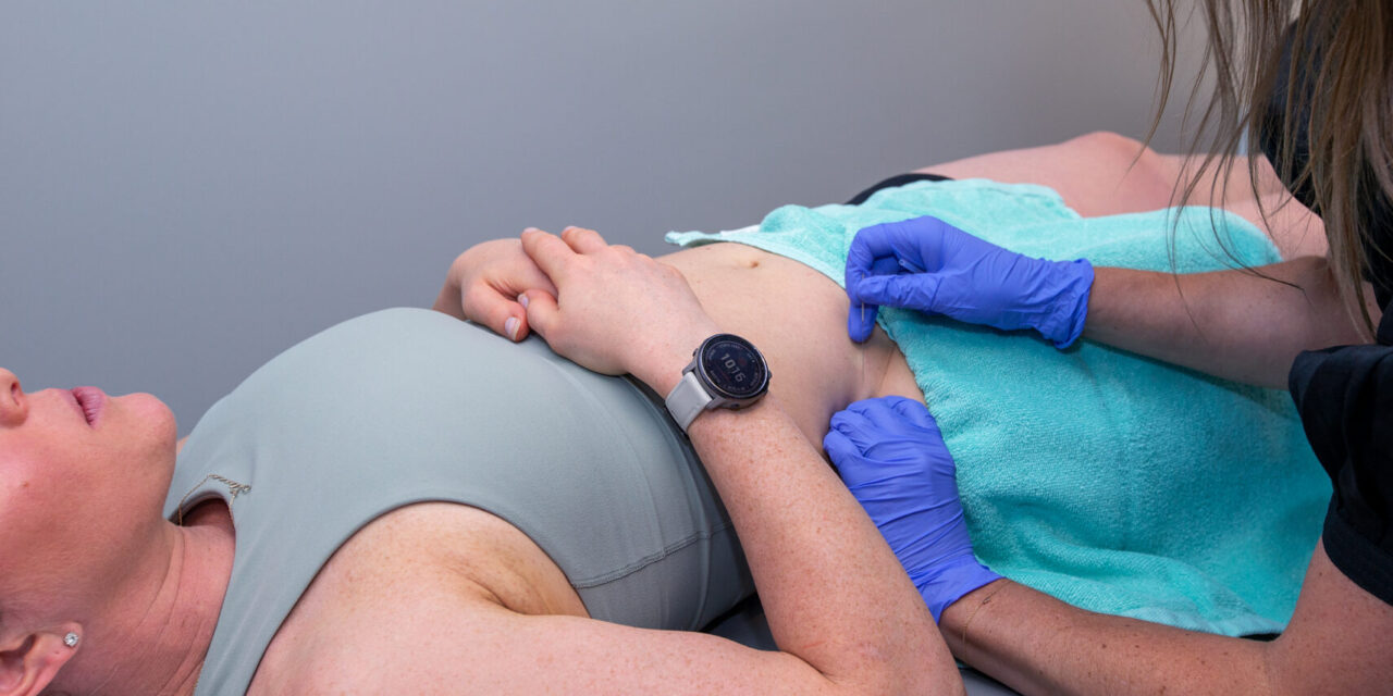 How Dry Needling Can Assist In The Treatment Of Pelvic Floor Impairments