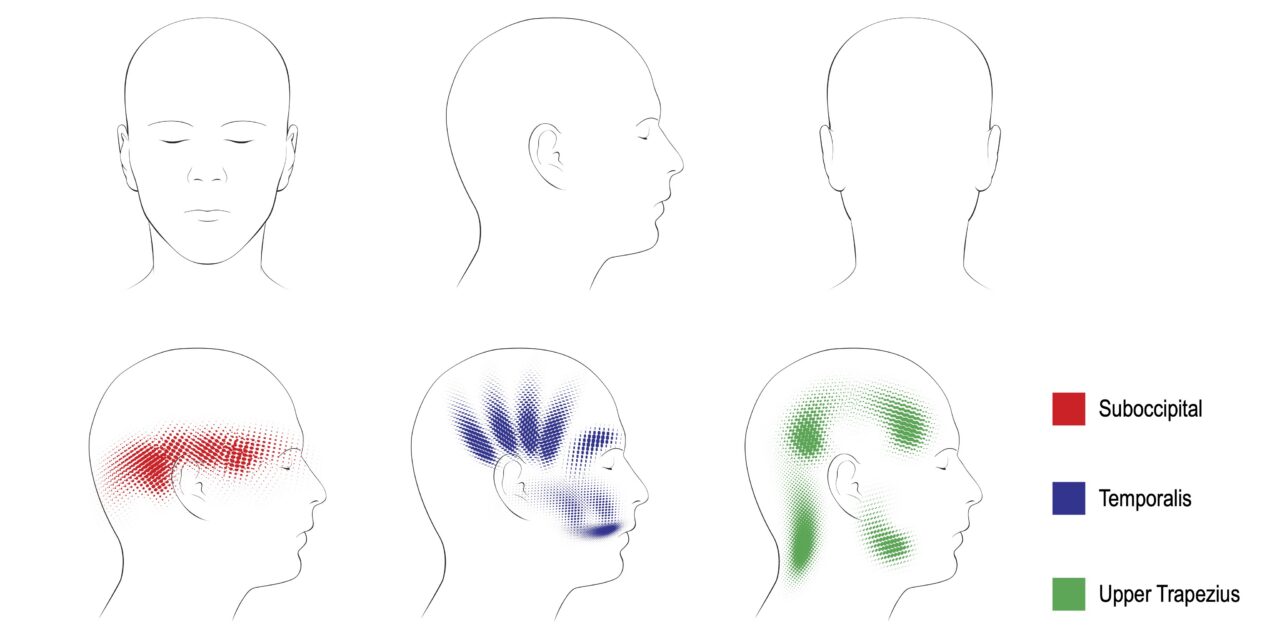 Treating Tension Headaches And Myofascial Pain With Dry Needling