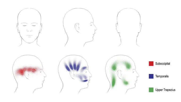 Tension Headache Referral Patterns