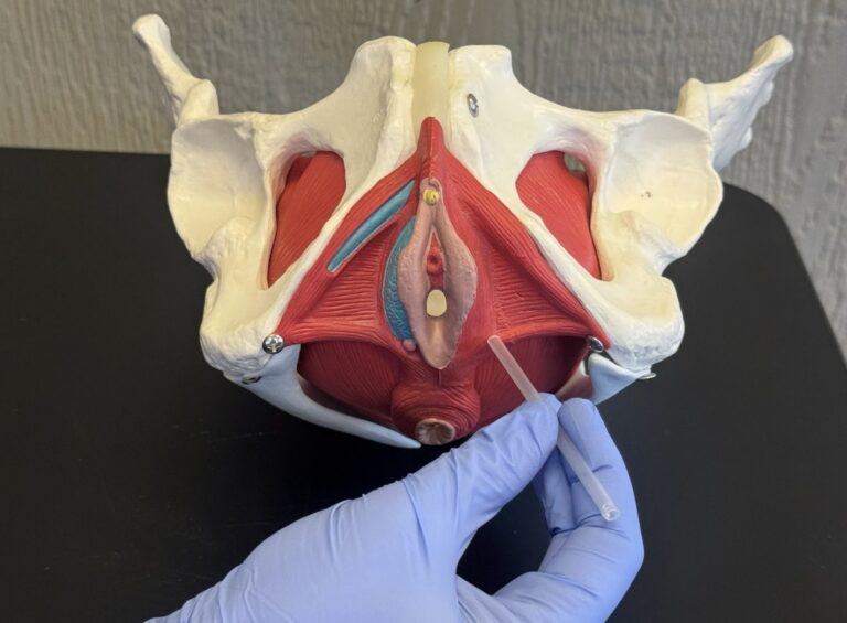 Dry needling for pain after perineal tears